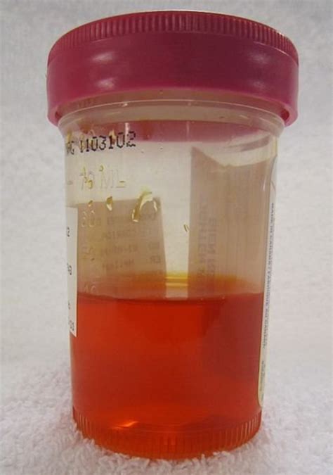Azo turning urine orange. ... pee with pelvic pain.2. OTHER URINE COLORS. There are many other reasons why you may experience a change in the color, consistency or smell of your urine. See ... 