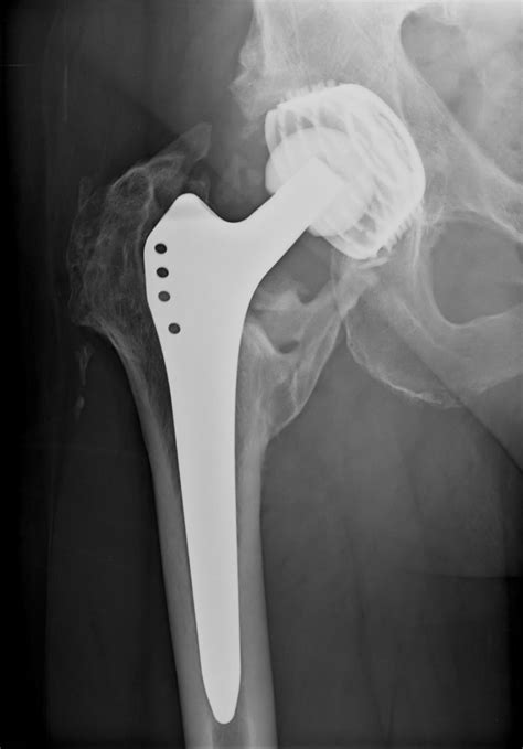 B.C. man launches class-action lawsuit over hip implant CTV News