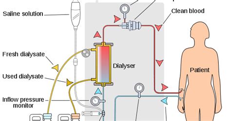 Bagaimana proses cuci darah pada penderita gagal g... - Roboguru - wintechmobiles.com