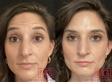 Before/After - muktibox.com