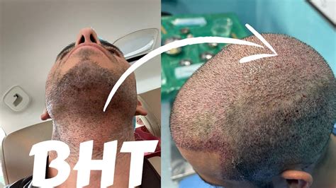 BHT Beard & Body Hair Transplants Using FUE · Bauman Medical