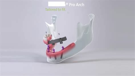 BLX ProArch step by step procedure - YouTube