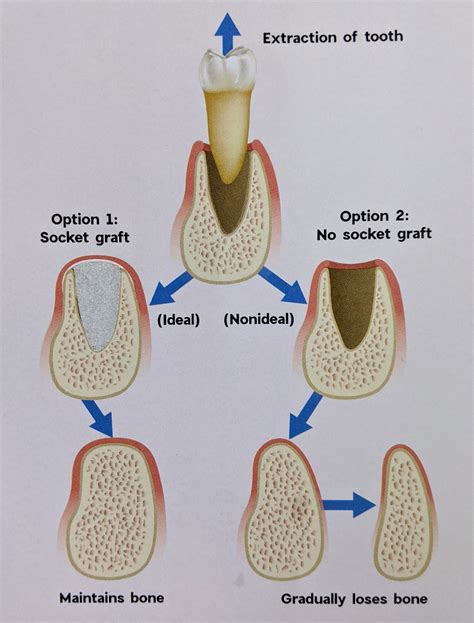 BONE CHANGES AFTER TOOTH EXTRACTION /orthodontic …