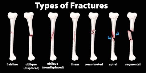 Bone fractures - Better Health Channel - wintechmobiles.com
