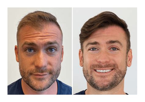 Bosley Hair Transplant & Restoration - Yelp - muktibox.com