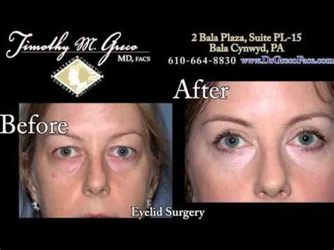 BOTOX Philadelphia and Bala Cynwyd by Dr. Tim Greco