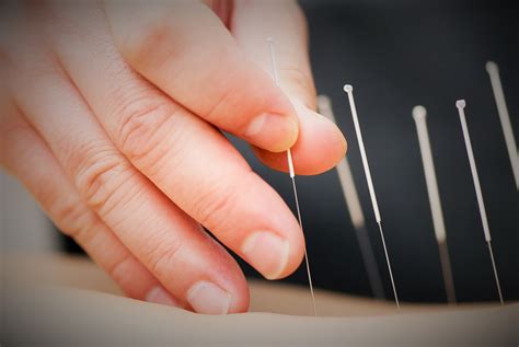 Bağcılar akupunktur