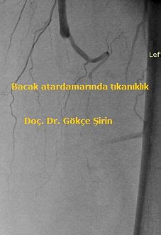 Bacakların ateroskleroza bağlı atardamar hastalıkları.