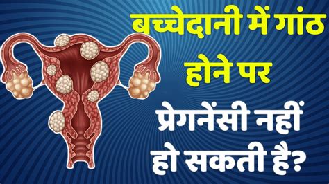 Bachedani me ganth hone se pregnancy hoti hai. .  <a href=https://agromax.r...