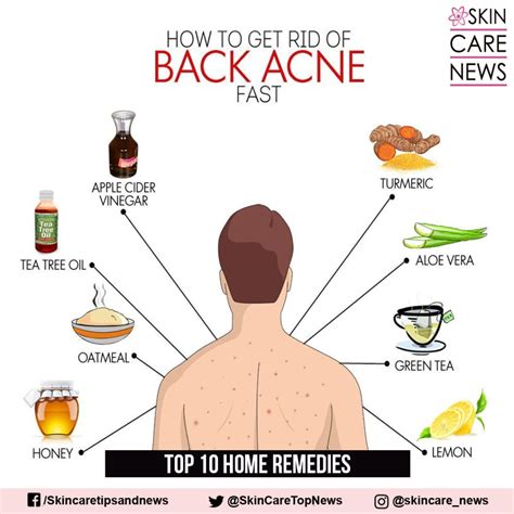 Back acne How to get rid of it and how to prevent it