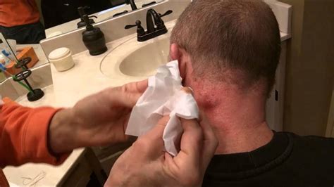 Back cyst popped. Sep 12, 2022 · Back with another Tiktok cyst popping video. This one is HUGE and erupts like a volcano. The cyst popper had to mitigate the spray for... Jaw Cyst September 18, 2022 . 