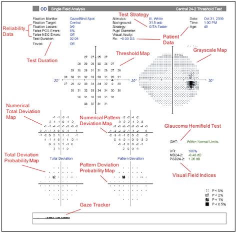 Back to Basics Visual Field Interpretation