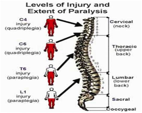 Baclofen and raised blood sugar levels Inspired Spinal Cord Injury ...