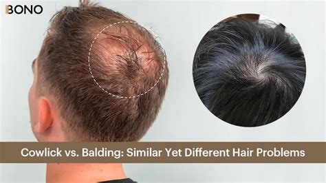Balding vs cowlick. This is going on 12 years now. Really large cowlicks are possible lol. hi, youre balding. It does look a little big for a cowlick. Plus the hair usually changes direction at a cowlick, and I don’t see that here. Balding for sure. Balding. 