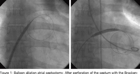 Balloon Dilation Atrial Septostomy and Potts Anastomosis