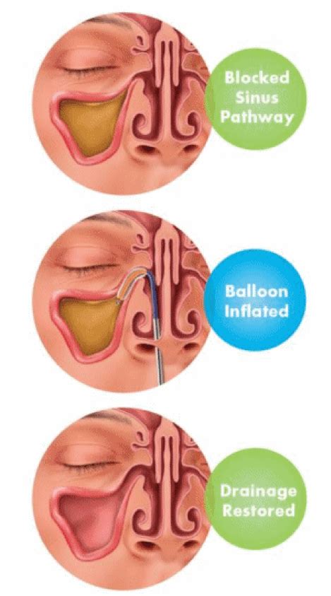 Balloon Ostial Dilation for Treatment of Chronic Sinusitis