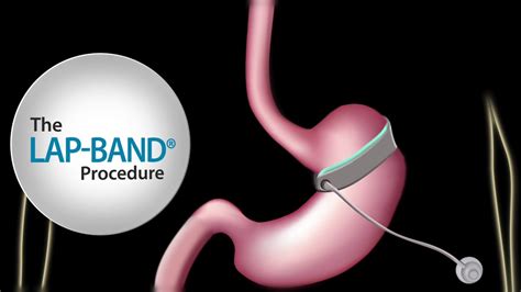 Band lap. Complications. Late postoperative complications after laparoscopic adjustable gastric banding include band slippage or prolapse, port or tubing malfunctions, pouch dilation, GERD, and band erosion ... 
