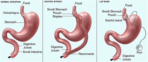 Bariatric Surgery - hhs.iowa.gov