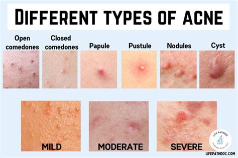 Barot caste category.  Acne affects teens and adults of all ages.  Learn ...