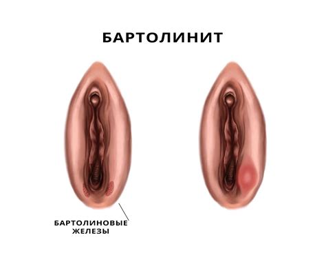 Bartolinit bild