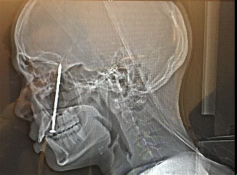 Bay Area carpenter gets nail shot through tongue into head, sues nail gun maker