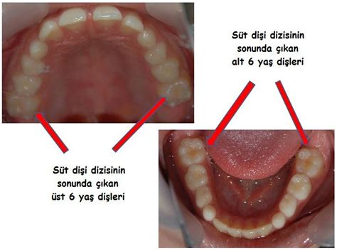 Bazen ağızda çıkmamış ancak diş filmlerinde görülen gömülü kalmış 20 yaş dişleri, yaşamımız boyunca ağızda bir sorun çıkarmadan yerinde durabiliyor.