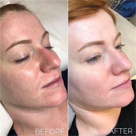 Bb glow treatment. BB glow is a complex treatment that is supposed to improve the texture, quality and tone of the face. It’s a fusion between the microneedling / nanoneedling facial and semi permanent makeup, so it targets a number of skin issues, and gives an anti-aging effect. 