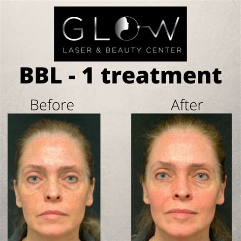 Bbl healing stages pictures. Being sun-sensitive for a couple of weeks. A mild sunburned appearance. Mild swelling. Mild skin sensitivity. It can take several weeks for your final results to emerge. During this time, your skin will produce healthy new collagen and shed unwanted pigmented cells. The result is brighter, clearer, plumper skin. 