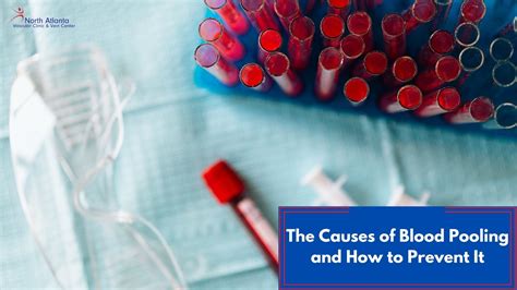 Beautiful Work Info About How To Prevent Blood Pooling Blockbath71
