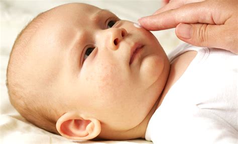 Bebeklerde cilt kuruluğu tedavisi
