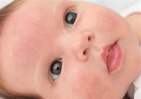 Bebeklerde ilaç alerjisi belirtileri