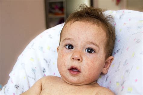 Bebeklerde mavi terleme hastalığı