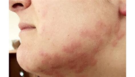 Bed Bug Bites On Face And Neck - Pest Phobia