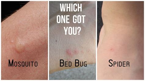 Bed bug bites icd 10. Nonvenomous insect bite of multiple sites with infection; Nonvenomous insect bites of multiple sites, with infection; injury NOS (T14.90) ICD-10-CM Diagnosis Code T07 T07 Unspecified multiple injuries 