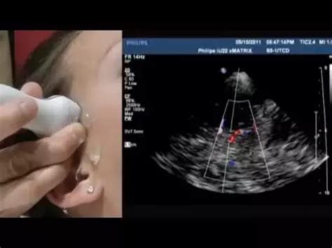 Bedside transcranial sonography monitoring in a patient with ...