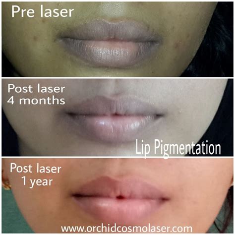 Before / After Images of pigmentation treatment Orchid Cosmo laser
