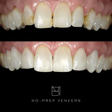 Before and After Veneers Cosmetic Dentist Tampa FL