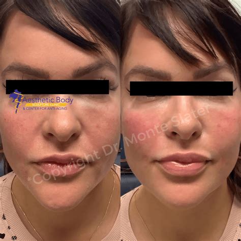 Before and after of 3 syringes of Restylane Lyft in cheeks and