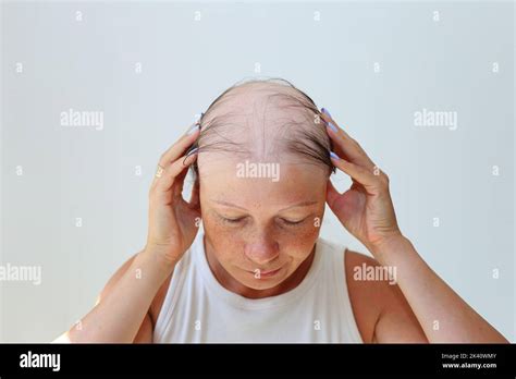 Befreien Sie sich von Haarausfall mit Alopezie-Haarperücken