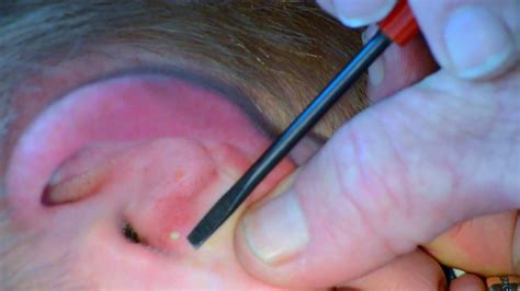Behind the ear pimple popping videos. Dec 7, 2020, 8:06 AM PST. Hollis Johnson/Insider. The coronavirus pandemic closed doctor's offices at the beginning of the year, but Dr. Pimple Popper was able to see her patients again in May and ... 