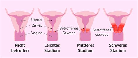 Beitrag zur lehre vom carcinom des uterus und der vagina. - Epson workforce 40 service manual repair guide.