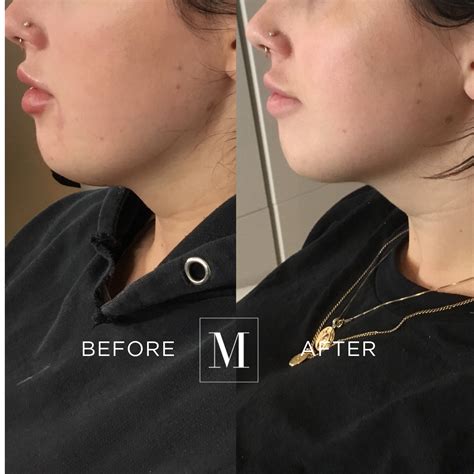 Belkyra™ Chin Fat Treatment Lakeshore Vein