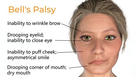 Bell'S Palsy 2022