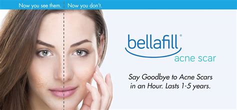 Bellafill near me. Bellafill® is a non-resorbable dermal filler that provides immediate and long-lasting results. It consists of a smooth collagen gel with polymethyl methacrylate (PMMA) microspheres. The collagen immediately adds volume to the skin, smoothing out wrinkles and scars, while the PMMA microspheres create a matrix that supports collagen … 