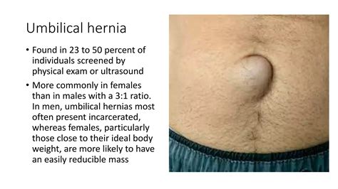 Belly button hernia.  Umbilical hernias are common and typically harmles...