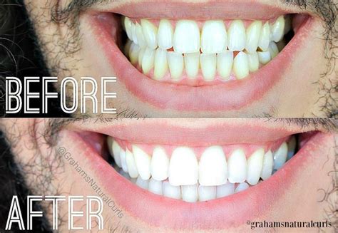 Benefits of Choosing Custom Fitted Teeth Whitening Trays - Smile …