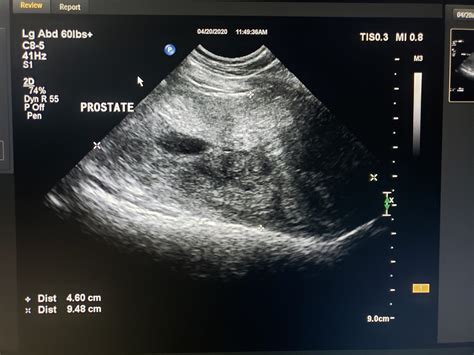 Benign Prostatic Hypertrophy and Prostatitis in Dogs