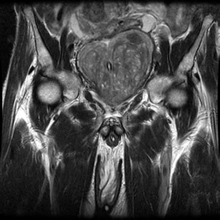 Benign prostatic hyperplasia Radiology Reference