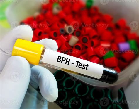 Benign prostatic hyperplasia blood in urine test, natural …