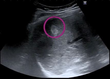 Benigne lezije na jetri